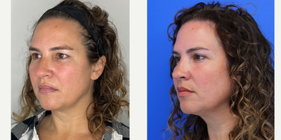 Case 9877 - 45-54 year old woman treated with Eyelid Surgery, Laser Resurfacing