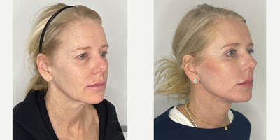 Case 9878 - 55-64 year old woman treated with Facelift, Neck Lift, Eyelid Surgery, Facial Fat Transfer, Laser Resurfacing, CO2 Laser