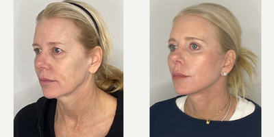 Case 9879 - 55-64 year old woman treated with Facelift, Neck Lift, Eyelid Surgery, Facial Fat Transfer, Laser Resurfacing, CO2 Laser