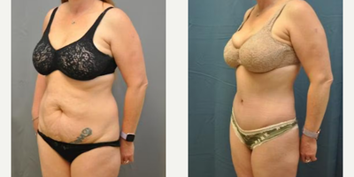 Case 988 - Woman treated with Tummy Tuck