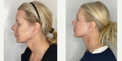 Case 9880 - 55-64 year old woman treated with Facelift, Neck Lift, Eyelid Surgery, Facial Fat Transfer, Laser Resurfacing, CO2 Laser
