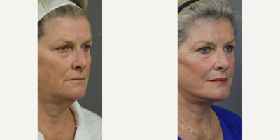 Case 9881 - Woman treated with Deep Plane Facelift, Neck Lift, Laser Resurfacing