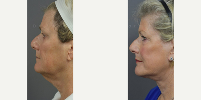 Case 9882 - Woman treated with Deep Plane Facelift, Neck Lift, Laser Resurfacing