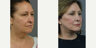 Case 9883 - Woman treated with Laser Resurfacing
