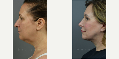 Case 9884 - Woman treated with Laser Resurfacing