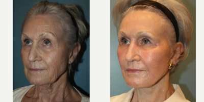 Case 9889 - 74 year old woman who had a Facelift, Neck Lift, Facial Fat Transfer and Laser Resurfacing