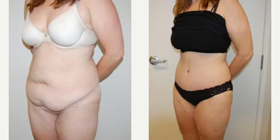 Case 989 - Woman treated with Tummy Tuck