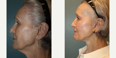 Case 9890 - 74 year old woman who had a Facelift, Neck Lift, Facial Fat Transfer and Laser Resurfacing