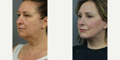 Case 9895 - Woman treated with Laser Resurfacing