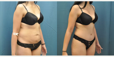 Case 990 - Woman treated with Tummy Tuck