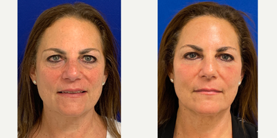Case 9900 - 55-64 year old woman treated with Laser Resurfacing