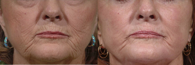 Case 9901 - Treated with Laser Resurfacing