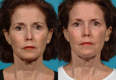 Case 9902 - Treated with Laser Resurfacing