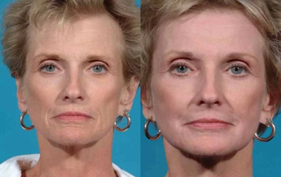 Case 9903 - 35-44 year old woman treated with Laser Resurfacing