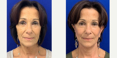 Case 9907 - 55-64 year old woman treated with Laser Resurfacing