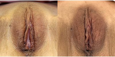Case: 9909 - before and after photo of 35-44 year old woman treated with Labiaplasty by Christine A. Hamori, MD