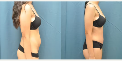 Case 991 - Woman treated with Tummy Tuck