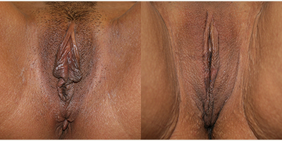 Case: 9911 - before and after photo of 31 year old woman treated with Labiaplasty by Christine A. Hamori, MD