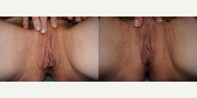 Case: 9914 - before and after photo of 57 yo had Labiaplasty of minora & majora,Clitoral Hood Reduction w/Clitoropexy,PRP to surgical Wound by Oscar A. Aguirre, MD, FPMRS