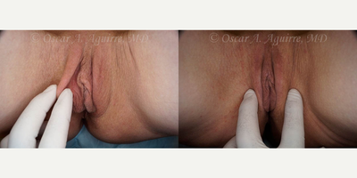 Case: 9917 - before and after photo of 57 yo had Labiaplasty of minora & majora,Clitoral Hood Reduction w/Clitoropexy,PRP to surgical Wound by Oscar A. Aguirre, MD, FPMRS
