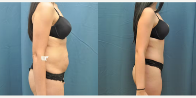 Case 992 - Woman treated with Tummy Tuck