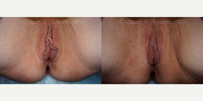 Case 9920 - 57 yo had Labiaplasty of minora & majora,Clitoral Hood Reduction w/Clitoropexy,PRP to surgical Wound
