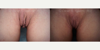Case 9921 - 57 yo had Labiaplasty of minora & majora,Clitoral Hood Reduction w/Clitoropexy,PRP to surgical Wound