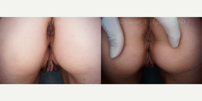 Case 9925 - 57 yo had Labiaplasty of minora & majora,Clitoral Hood Reduction w/Clitoropexy,PRP to surgical Wound
