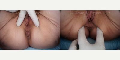 Case 9929 - 57 yo had Labiaplasty of minora & majora,Clitoral Hood Reduction w/Clitoropexy,PRP to surgical Wound