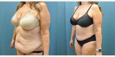 Case 993 - Woman treated with Tummy Tuck