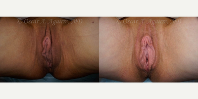 Case 9937 - 53 yo had Labia Majora Reduction, Labiaplasty of Minora, Clitoral Hood Reduction and Clitoropexy