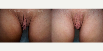 Case 9939 - 53 yo had Labia Majora Reduction, Labiaplasty of Minora, Clitoral Hood Reduction and Clitoropexy