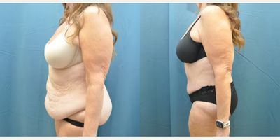 Case 994 - Woman treated with Tummy Tuck