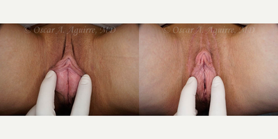 Case 9948 - 53 yo had Labia Majora Reduction, Labiaplasty of Minora, Clitoral Hood Reduction and Clitoropexy