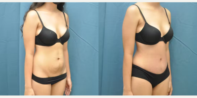 Case 995 - Woman treated with Tummy Tuck