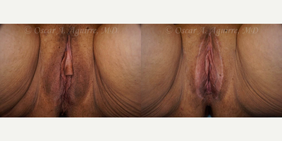 Case 9957 - 48 yo had Labia Majora Reduction,Laser Reduction Labiaplasty of Minora,Clitoral Hood Reduction,