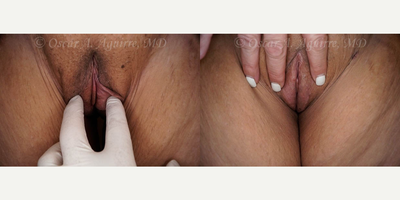 Case 9958 - 48 yo had Labia Majora Reduction,Laser Reduction Labiaplasty of Minora,Clitoral Hood Reduction,