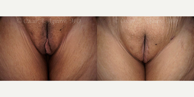 Case 9959 - 48 yo had Labia Majora Reduction,Laser Reduction Labiaplasty of Minora,Clitoral Hood Reduction,
