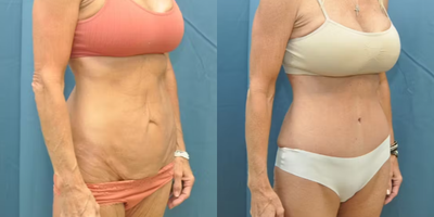 Case 996 - Woman treated with Tummy Tuck