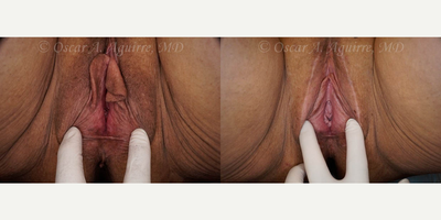 Case 9960 - 48 yo had Labia Majora Reduction,Laser Reduction Labiaplasty of Minora,Clitoral Hood Reduction,