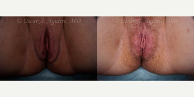 Case 9969 - 28 yo woman treated with Revision Labiaplasty of labia Majora and Excision of Excess Perineal Skin