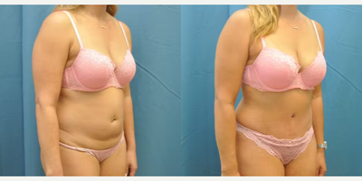 Case 997 - Woman treated with Tummy Tuck