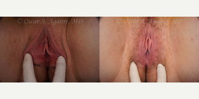 Case 9970 - 28 yo woman treated with Revision Labiaplasty of labia Majora and Excision of Excess Perineal Skin