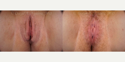 Case 9971 - 28 yo woman treated with Revision Labiaplasty of labia Majora and Excision of Excess Perineal Skin