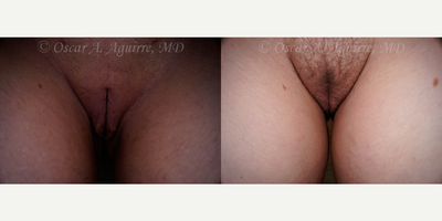Case 9972 - 28 yo woman treated with Revision Labiaplasty of labia Majora and Excision of Excess Perineal Skin