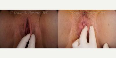 Case 9975 - 28 yo woman treated with Revision Labiaplasty of labia Majora and Excision of Excess Perineal Skin