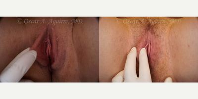 Case 9976 - 28 yo woman treated with Revision Labiaplasty of labia Majora and Excision of Excess Perineal Skin