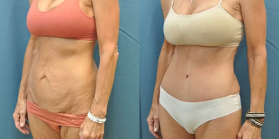 Case 998 - Woman treated with Tummy Tuck