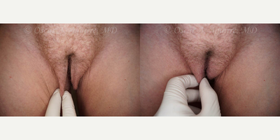 Case 9986 - 61 yo had Labia Majora Reduction,Vaginoplasty,Anal Tag Excision,Vaginal Hysterectomy,Vaginal Repair