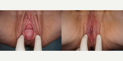 Case 9987 - 61 yo had Labia Majora Reduction,Vaginoplasty,Anal Tag Excision,Vaginal Hysterectomy,Vaginal Repair